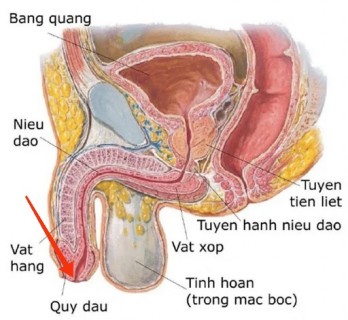 Hẹp lỗ sáo thumb